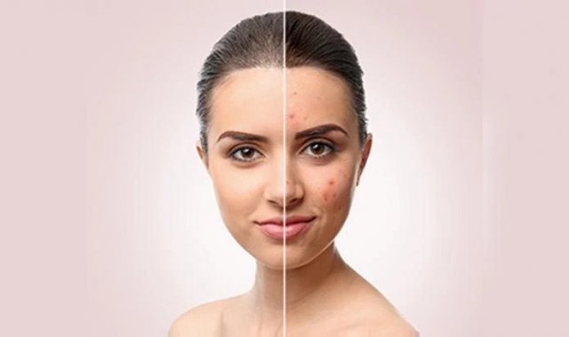 Women And People With Darker Skin Suffer From The Psychological Effects of ACNE